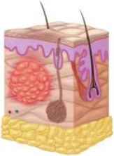  -Which of the following, pictured here, is a closed wound with bruising? A)  Contusion B)  Abrasion C)  Laceration D)  Puncture E)  Incision