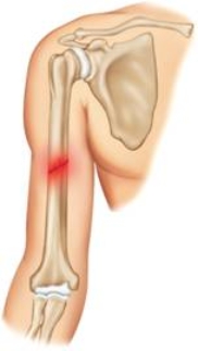 The fracture pictured here is a(n) ____. A) greenstick fracture B) comminuted fracture C) closed fracture D) incomplete fracture E) open fracture