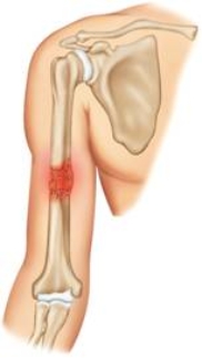 Which of the following is pictured here?   A)  Greenstick fracture B)  Comminuted fracture C)  Closed fracture D)  Incomplete fracture E)  Open fracture