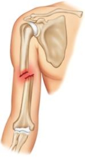 What type of fracture is pictured here?   A)  Greenstick fracture B)  Comminuted fracture C)  Open fracture D)  Complete fracture E)  Incomplete fracture