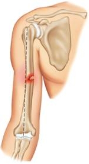 The fracture pictured here, which occurs most often in children, is a(n)  ____.   A)  greenstick fracture B)  comminuted fracture C)  open fracture D)  complete fracture E)  dislocation