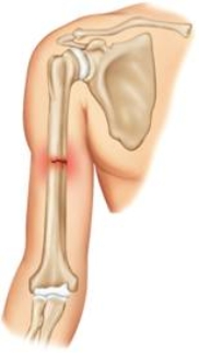 Which of the following is this fracture?   A)  Greenstick fracture B)  Complete fracture C)  Comminuted fracture D)  Open fracture E)  Incomplete fracture