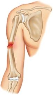 Which type of fracture is pictured here?   A)  Greenstick fracture B)  Comminuted fracture C)  Open fracture D)  Closed fracture E)  Dislocation