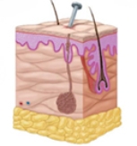   -What type of wound is pictured here? A)  Laceration B)  Puncture C)  Abrasion D)  Contusion E)  Incision