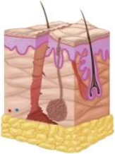 What type of wound is pictured here?   A)  Laceration B)  Puncture C)  Abrasion D)  Contusion E)  Incision