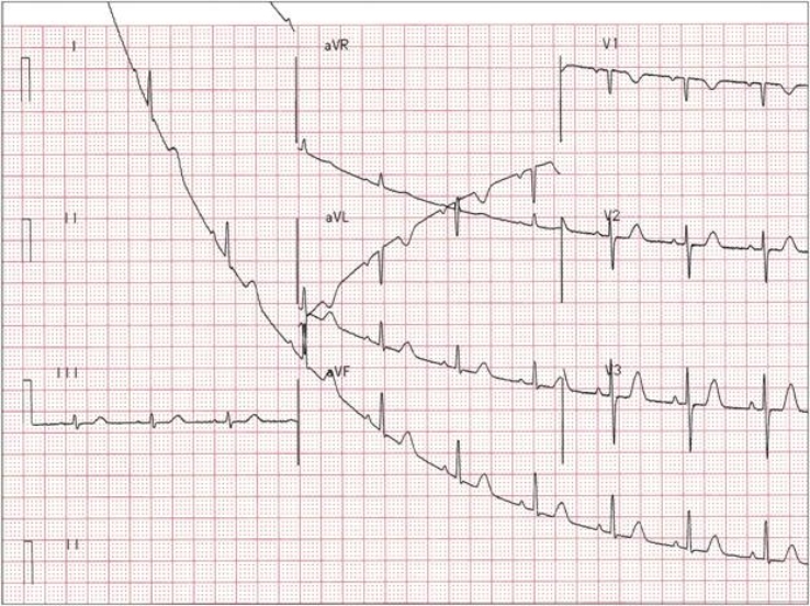   -After preparing the ECG machine, you explained the procedure to Mrs. Thomas, connected the electrodes, and began the tracing, as shown in the picture. You rechecked the electrodes and they are all placed correctly. None of the wires are loose. However, you notice that Mrs. Thomas's skin smells fragrant, as though she has used a body lotion recently. Which of the following describes the problem, its possible cause, and the correct solution? A)  Extraneous marks caused by paper clips; remove the paper clips B)  Somatic interference caused by patient shivering; offer a warm blanket C)  Wandering baseline caused by lotion on the skin; re-prep the skin with isopropyl alcohol D)  AC interference caused by nearby equipment; turn equipment off E)  Flat line caused by crossed wires; reconnect the wires correctly