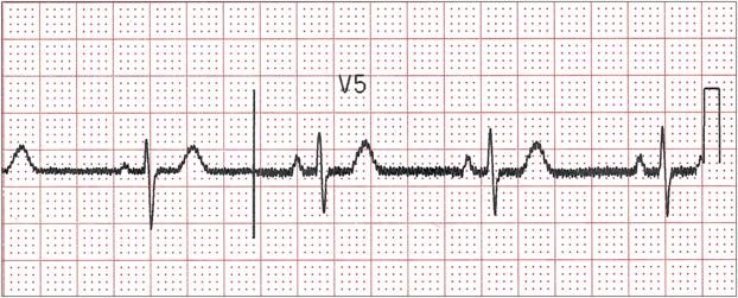   -The urgent care center where you work is being remodeled, and the room usually used for obtaining ECGs is currently unavailable. The ECG equipment has been moved around the corner to the room next to the X-ray room. When you begin your first patient ECG of the day, the tracing looks as shown in the figure. What problem is present and how can you fix it? A)  Extraneous marks; avoid using paper clips on the graph paper B)  Somatic interference; ask the patient to be very still while you record the ECG C)  Wandering baseline; check and reconnect loose leads D)  Flat line; check for crossed wires or loose leads E)  AC interference; move the ECG equipment to a room farther from other electric equipment