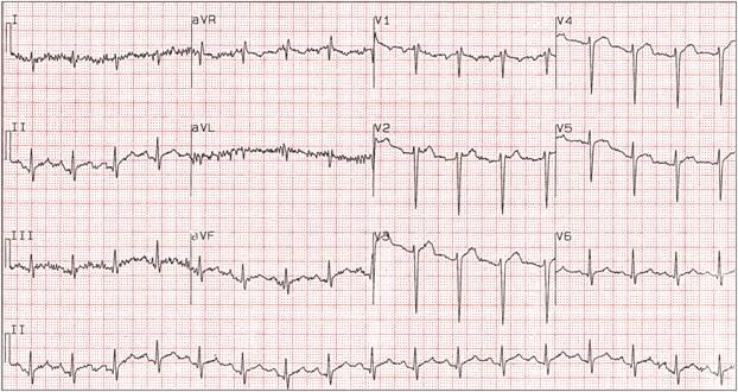   -You are attempting to record an ECG for Mr. Potter, a 72-year-old patient who has Parkinson's disease. Knowing this, you automatically place the limb electrodes close to the trunk. However, the tracing looks as shown in the picture. What artifact is present and what can you do to fix it? A)  Extraneous marks; avoid using paper clips on the graph paper B)  Somatic interference; wait until Mr. Potter's tremors subside C)  wandering baseline; check for loose electrodes D)  AC interference; turn off nearby electrical equipment E)  Flat line; check pulse and respiration, then begin CPR