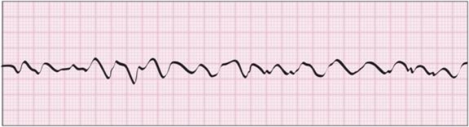 <strong> What is the arrhythmia pictured here?</strong> A) Atrial fibrillation B) PVCs C) Ventricular fibrillation D) Bundle branch block E) Cardiac arrest
