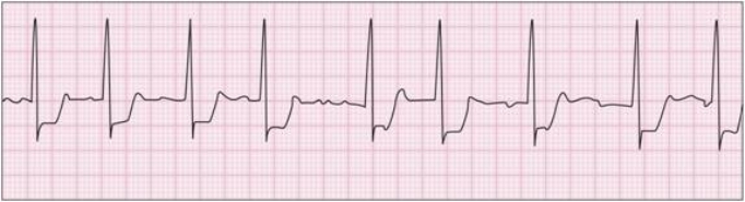 <strong> The arrhythmia pictured here is ____.</strong> A) atrial fibrillation B) PVCs C) ventricular fibrillation D) bundle branch block E) cardiac arrest