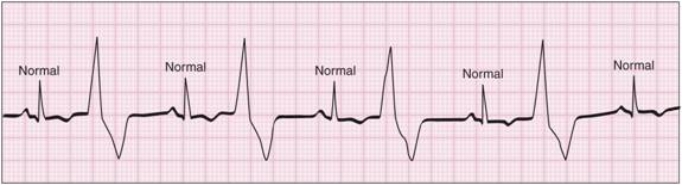   -What is the arrhythmia pictured here? A)  Atrial fibrillation B)  PVCs C)  Ventricular fibrillation D)  Bundle branch block E)  Cardiac arrest