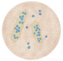 You are performing a microscopic examination of Mr. Henderson's urine sample. Under high-power magnification, you see the items shown in the picture. Which of the following is the most likely cause?   A)  Vigorous exercise B)  Pyelonephritis C)  Heavy-metal poisoning D)  Renal ischemia E)  Allergic reaction