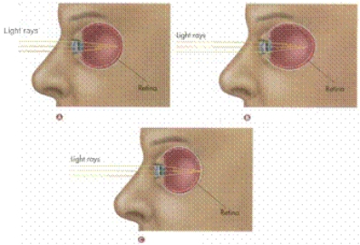   -Letter B in the figure is an example of a condition called ________, in which an elongated eyeball causes light rays to be focused in front of the retina.