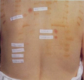 The patient in the figure has been tested for allergies using a(n) ________ test.