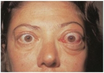 The nurse is caring for a client with Graves disease.When observing the facial features of the client (pictured below) ,the nurse notes that the client is exhibiting which associated sign of the disease?   A) Conjunctivitis B) Lacrimation C) Periorbital edema D) Exophthalmos