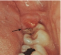   -What is the client's most likely problem? A)  Gingival abscess B)  Pericoronitis C)  Necrotizing ulcerative gingivitis D)  Necrotizing ulcerative periodontitis