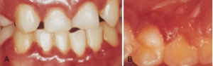   -The ulcer is most likely: A)  Angular cheilitis B)  Herpes simplex labialis C)  Herpetic whitlow D)  Herpetic gingivostomatitis