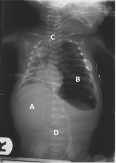 An infant with a pneumothorax has the following chest x-ray result. Which area should the nurse identify as being the pneumothorax?   A)  A B)  B C)  C D)  D
