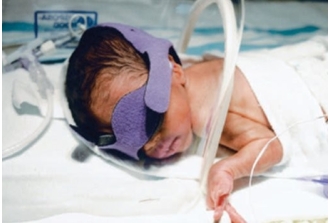 The nurse sees the following patient in the neonatal intensive care unit and realizes that additional care will need to be provided for which health problem?   A)  Hypotension B)  Hypoglycemia C)  Hyperglycemia D)  Hyperbilirubinemia