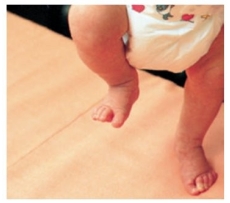 While conducting a home visit, the nurse observes the father of a newborn hold the infant so that the following is observed. What should the nurse explain to the parents about this behavior?   A)  This is abnormal and should be reported. B)  This will disappear between 4 and 8 weeks of age. C)  It means the child will begin walking at an early age. D)  The infant should be given more formula when this occurs.