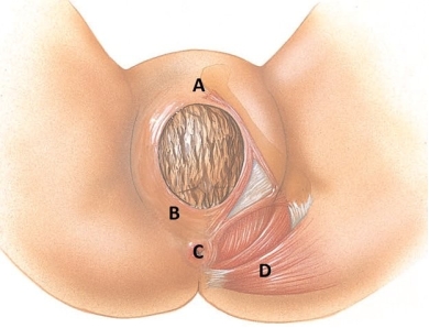 The healthcare provider of a laboring patient is considering a mediolateral episiotomy. On the following diagram, identify where this incision should be made.   A)  A B)  B C)  C D)  D