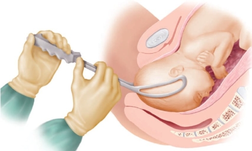 Forceps are being used to deliver the fetus of a laboring patient, as identified in the diagram. In which direction should the healthcare provider use the forceps to guide the fetus for delivery?   A)  Upward and outward B)  Downward and outward C)  Midline and towards the left D)  Midline and toward the right