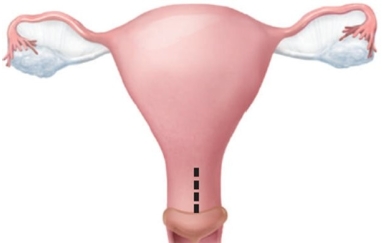 A patient is scheduled to have the following type of incision for a cesarean birth. What advantage should the nurse explain to the patient that this type of incision has?   A)  Easier to repair B)  Less blood loss C)  Expedites delivery of multiple fetuses D)  Less likely to rupture with future pregnancies
