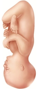 A laboring patient is attempting a vaginal birth. An episiotomy has already been performed and the healthcare provider is prepared to extend the episiotomy if necessary. What is this fetus's most likely presentation? A)    B)    C)    D)   