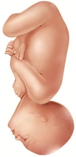 A laboring patient is attempting a vaginal birth. An episiotomy has already been performed and the healthcare provider is prepared to extend the episiotomy if necessary. What is this fetus's most likely presentation? A)    B)    C)    D)   