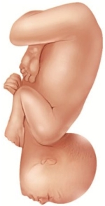 A laboring patient is attempting a vaginal birth. An episiotomy has already been performed and the healthcare provider is prepared to extend the episiotomy if necessary. What is this fetus's most likely presentation? A)    B)    C)    D)   