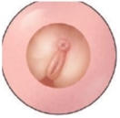 During an intrapartum vaginal examination the following is palpated. In which type of presentation is this fetus?   A)  Breech B)  Shoulder C)  Occiput face D)  Occiput brow