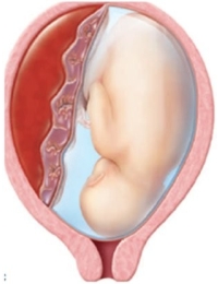 A pregnant patient is diagnosed with premature separation of the placenta. The nurse provides the patient with the following diagram. What amount of placenta separation is this patient experiencing?   A)  Central B)  Marginal C)  Complete D)  Anticipated