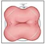 A pregnant patient is scheduled to have the procedure depicted in the diagram performed. What should the nurse explain is the purpose for this procedure?   A)  Correct marginal placenta previa B)  Prevent preterm cervical dilatation and pregnancy loss C)  Reduce the risk of developing central abruptio placentae D)  Assist the fetus to rotate into the appropriate position for delivery