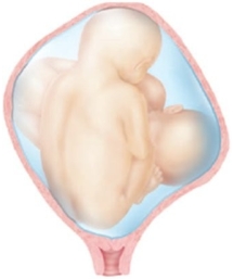 A patient pregnant with twins late in the 3rd trimester has an ultrasound that shows the position of the fetuses as follows. What should the nurse expect will be planned for this patient?   A)  Cesarean birth B)  Vaginal delivery C)  Spinal block during labor D)  Continuous lumbar epidural