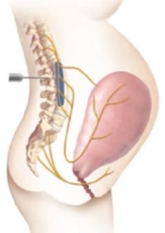 The nurse is preparing to instruct a patient in the third trimester of pregnancy on various methods to control pain during labor, and selects the following diagram. For which type of pain control is the nurse planning to instruct the client?   A)  Lumbar spinal block B)  Pudendal block C)  Lumbar epidural block D)  Local infiltration