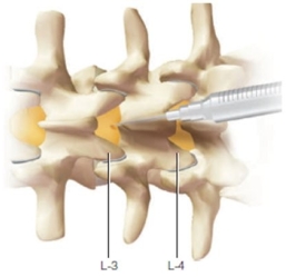 The nurse is reviewing the procedure for a continuous lumbar epidural block with a patient in the 3<sup>rd</sup> trimester of pregnancy. When reviewing this information what does the following diagram demonstrate to the patient?   A)  Preparation of the skin prior to the insertion of the catheter B)  Status of the vertebra when the patient is in the correct position C)  The length of the needle to be inserted in the subarachnoid space D)  Vertebrae rotated forward when the patient is side-lying without a pillow