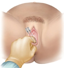<strong>A patient is having the following anesthesia provided. What is the purpose of this type of anesthesia? </strong> A) Repair of an episiotomy B) Delivery of the placenta C) Insertion of a urinary catheter D) Intrapartum vaginal examination