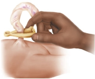 A newborn has the following applied to the umbilical cord.   What should the nurse instruct the new parents about regarding this device? A)  It has to stay intact for at least one week B)  It is removed in 24 hours if the cord has dried C)  It eliminates the need to wash the infant's abdomen D)  It is removed by cutting the tissue beneath the clamp