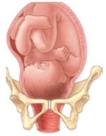 <strong>During an intrapartum vaginal examination the nurse palpates the following:   Based upon this information, which diagram best describes the fetal descent and station? </strong> A)   B)   C)   D)   <div style=padding-top: 35px> 