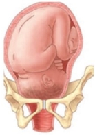 <strong>During an intrapartum vaginal examination the nurse palpates the following:   Based upon this information, which diagram best describes the fetal descent and station? </strong> A)   B)   C)   D)   <div style=padding-top: 35px> 