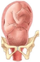 <strong>During an intrapartum vaginal examination the nurse palpates the following: Based upon this information, which diagram best describes the fetal descent and station? </strong> A) B) C) D)