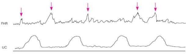 A laboring patient being monitored has the following rhythm strip:   How should the nurse interpret this finding? A)  Early decelerations B)  Periodic accelerations C)  Episodic accelerations D)  Variable decelerations with overshoot