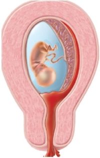 The nurse prepares teaching material for a patient who is experiencing a spontaneous abortion. Based upon the material selected, which type of abortion is the patient experiencing?   A)  Threatened B)  Imminent C)  Incomplete D)  Complete