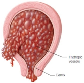 A female patient seeks medical attention for vaginal discharge that at times is bright red but is mostly dark brown in color. When preparing materials to share with this patient, why should the nurse include this diagram?   A)  It shows the size of the uterus. B)  It explains the location of the cervix. C)  It portrays the vessels within the uterus. D)  It demonstrates the location of the uterus.