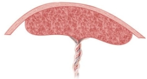 A pregnant patient is completing an ultrasound to grade the integrity of the placenta. Which diagram should the nurse provide to the patient if the findings are grade 0? A) B) C) D)