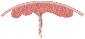 A pregnant patient is completing an ultrasound to grade the integrity of the placenta. Which diagram should the nurse provide to the patient if the findings are grade 0? A) B) C) D)