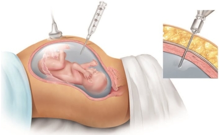 The nurse provides the following diagram to a patient in the 3<sup>rd</sup> trimester of pregnancy. For which diagnostic test is the nurse preparing this patient?   A)  Ultrasound B)  Amniocentesis C)  Biophysical profile D)  Contraction stress test