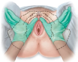 A pregnant patient is having pelvic measurements made. Which approach should the examiner use to determine this patient's estimated length of the pubic ramus? A) B) C) D)