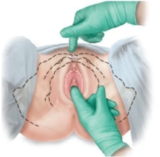 A pregnant patient is having pelvic measurements made. Which approach should the examiner use to determine this patient's estimated length of the pubic ramus? A) B) C) D)