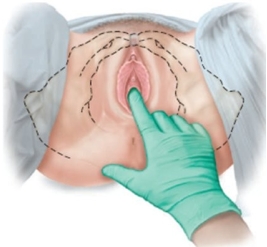A pregnant patient is having pelvic measurements made. Which approach should the examiner use to determine this patient's estimated length of the pubic ramus? A) B) C) D)